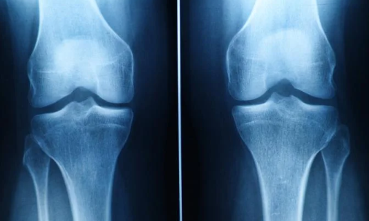 연골 손상이 되어 통증과 뻑뻑함 움직임의 제한이 나타날 수 있는 무릎